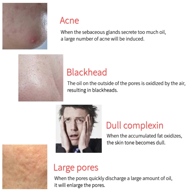 Oil Absorbing Facial Pore Cleaning Roller Facial Treatment Healthy Skin Volcanic Oil Absorbing Roller Skincare Best Oil Absorbing Roller