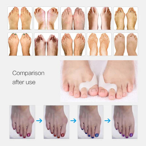 Gel Bunion Toe Corrector