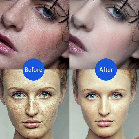 Skin Care Laser Pen Freckle Tattoo Skin Spots Mole Wart Pimple Verrugas Removal Pen
