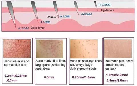Derma Roller For Hyperpigmentation