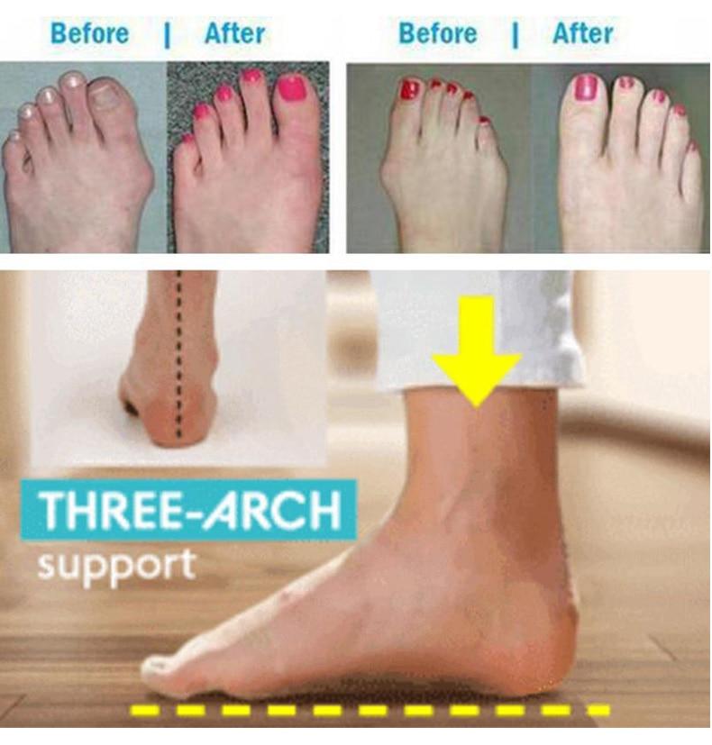 Bunion Correction Orthopedic Sandal